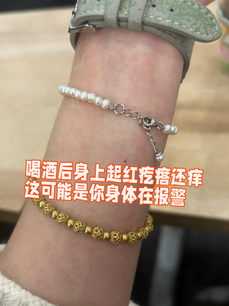 1. 酒精过敏:有些人对酒精中