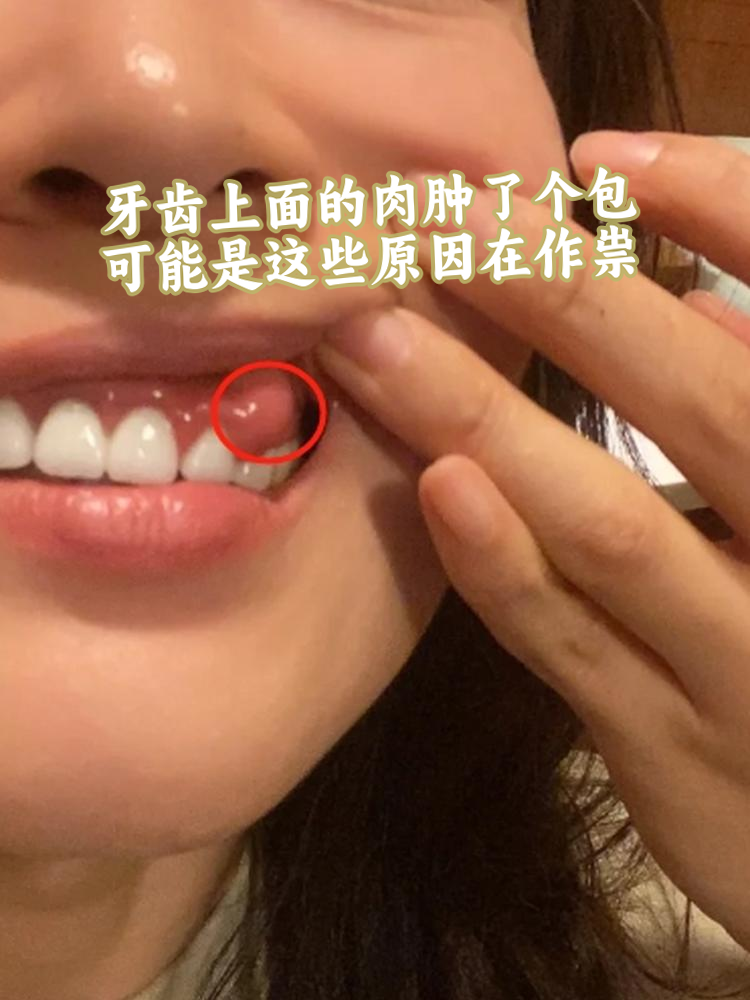 牙齿上面的肉肿了个包,别慌,多半是有原因的
