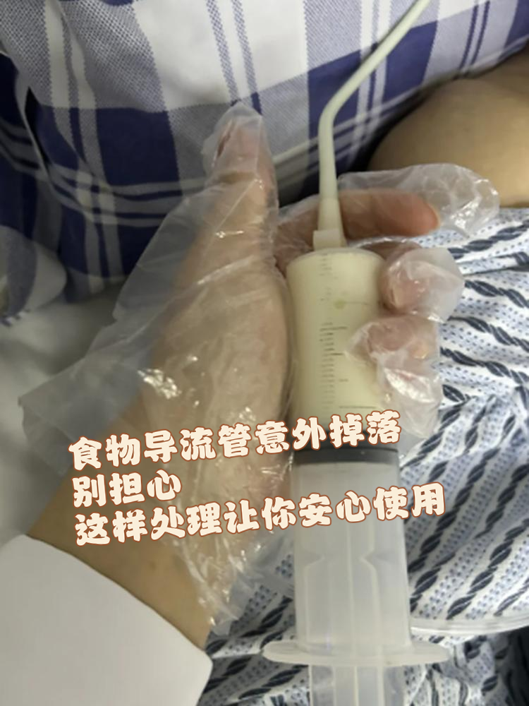 食物导流管意外掉落的时候,可能会让你感到手足无措,不知如何处理