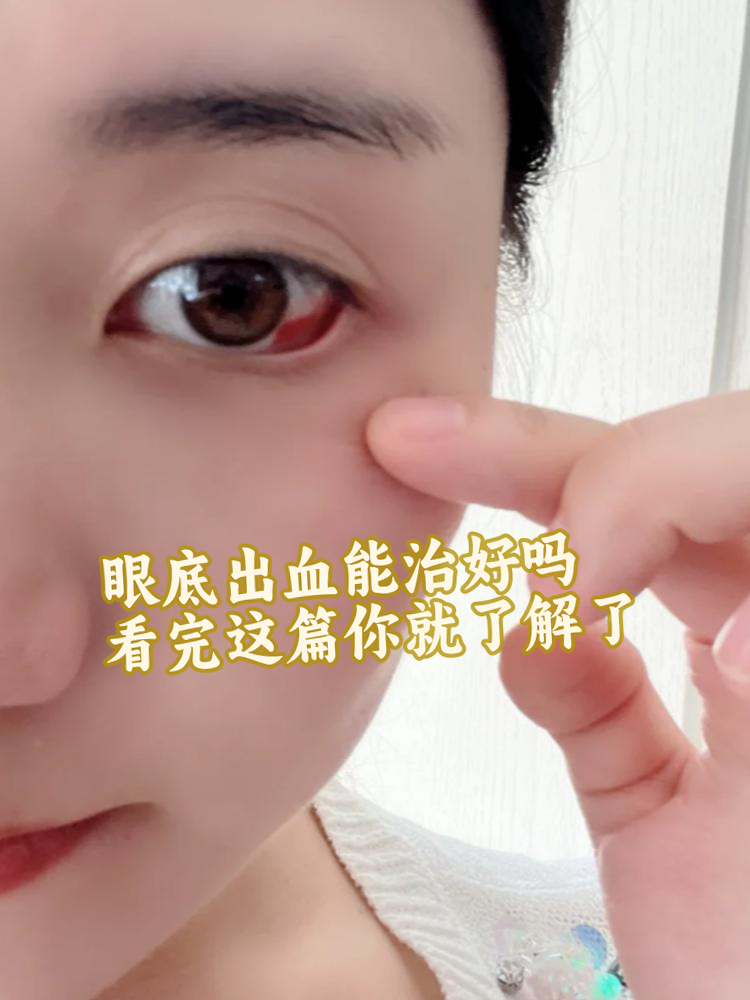 眼睛为什么会出血 眼睛为什么会出血