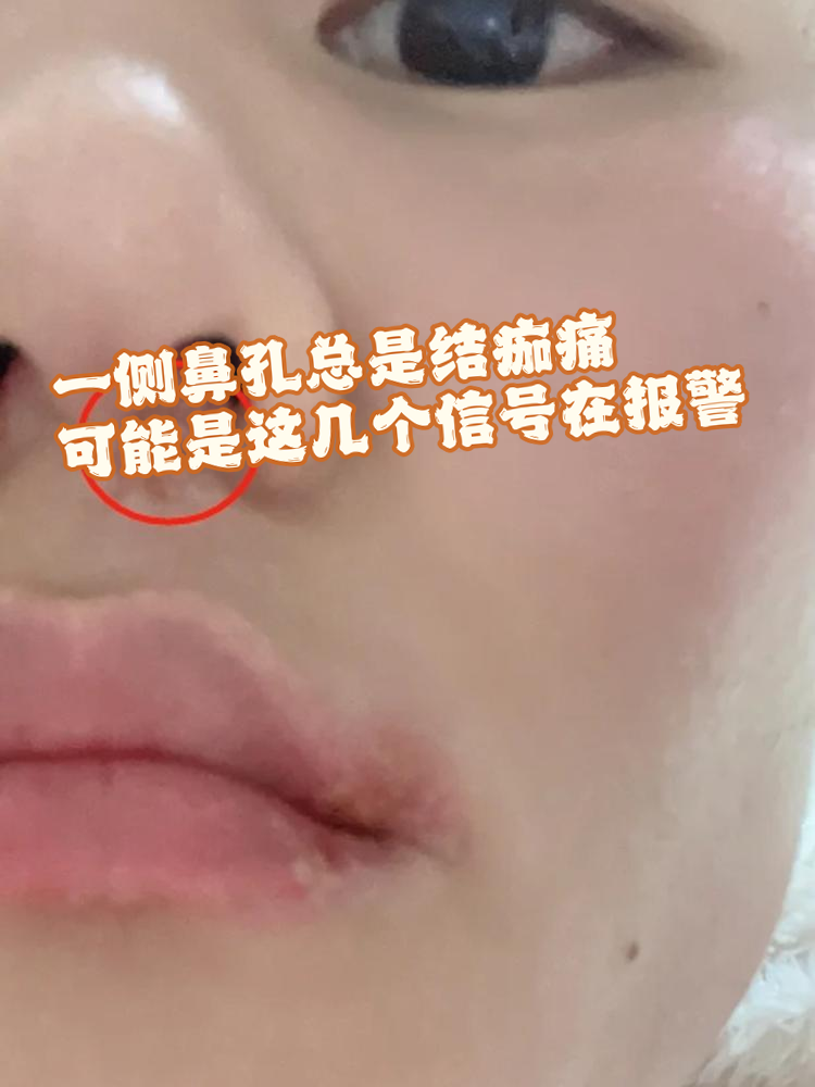 鼻黏膜干燥引起的结痂问题