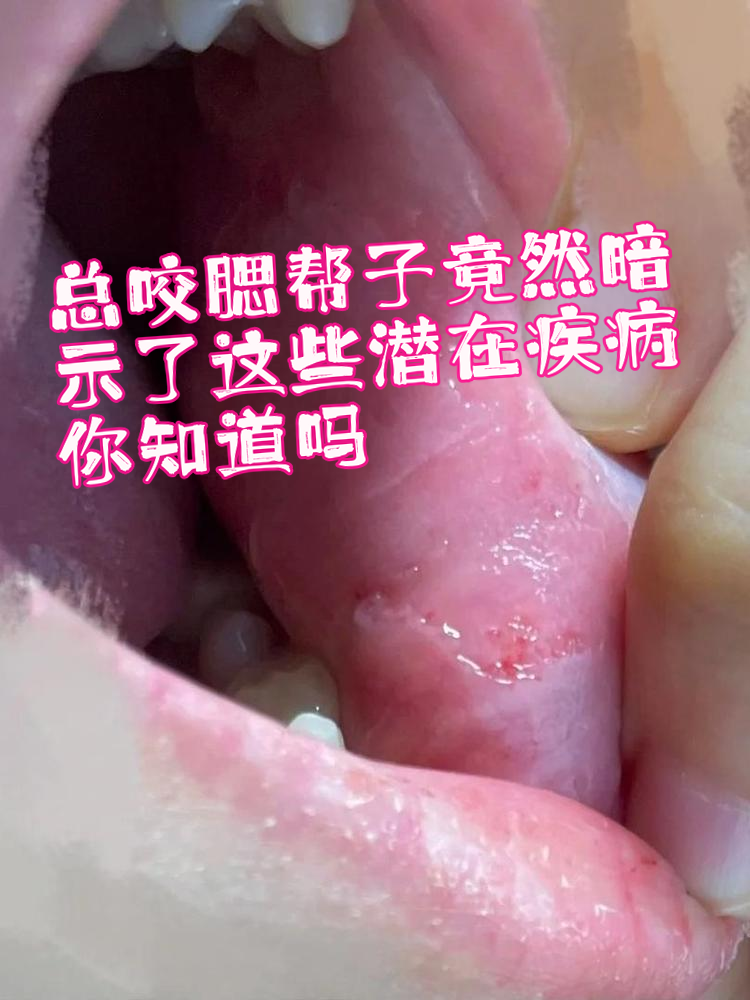 腮腺炎的准确部位图片和症状腮帮子里面溃疡图片腮腺炎的症状有哪些腮