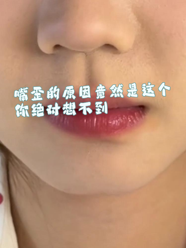嘴歪的问题常让人感到困惑,影响美观和自信