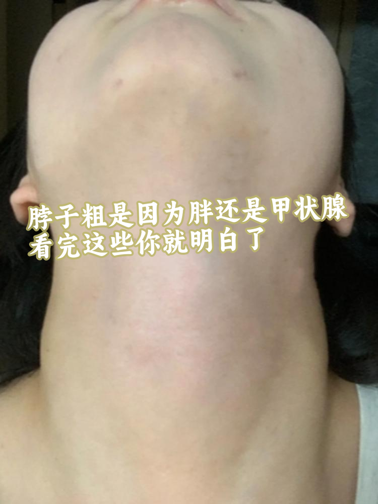 脖子粗是因为胖还是甲状腺?看完这些你就明白了!