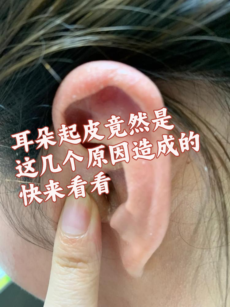 很少有人注意到耳朵起皮的问题,其实背后暗藏的原因可不少