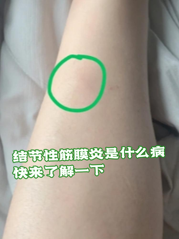 结节性筋膜炎,哇,听起来是不是有点吓人?