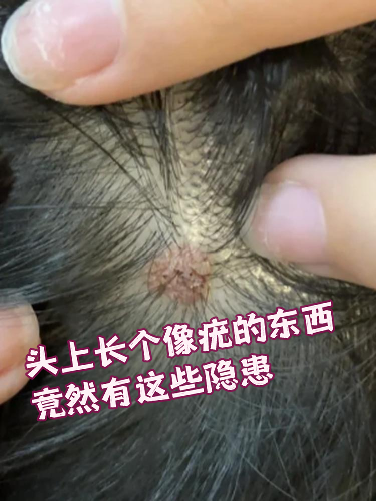 头上长个像疣的东西,竟然有这些隐患!