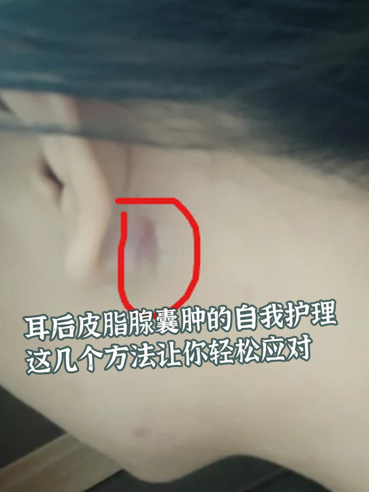 耳后皮脂腺囊肿虽然不是什么大病,但可能会带来一些小烦恼
