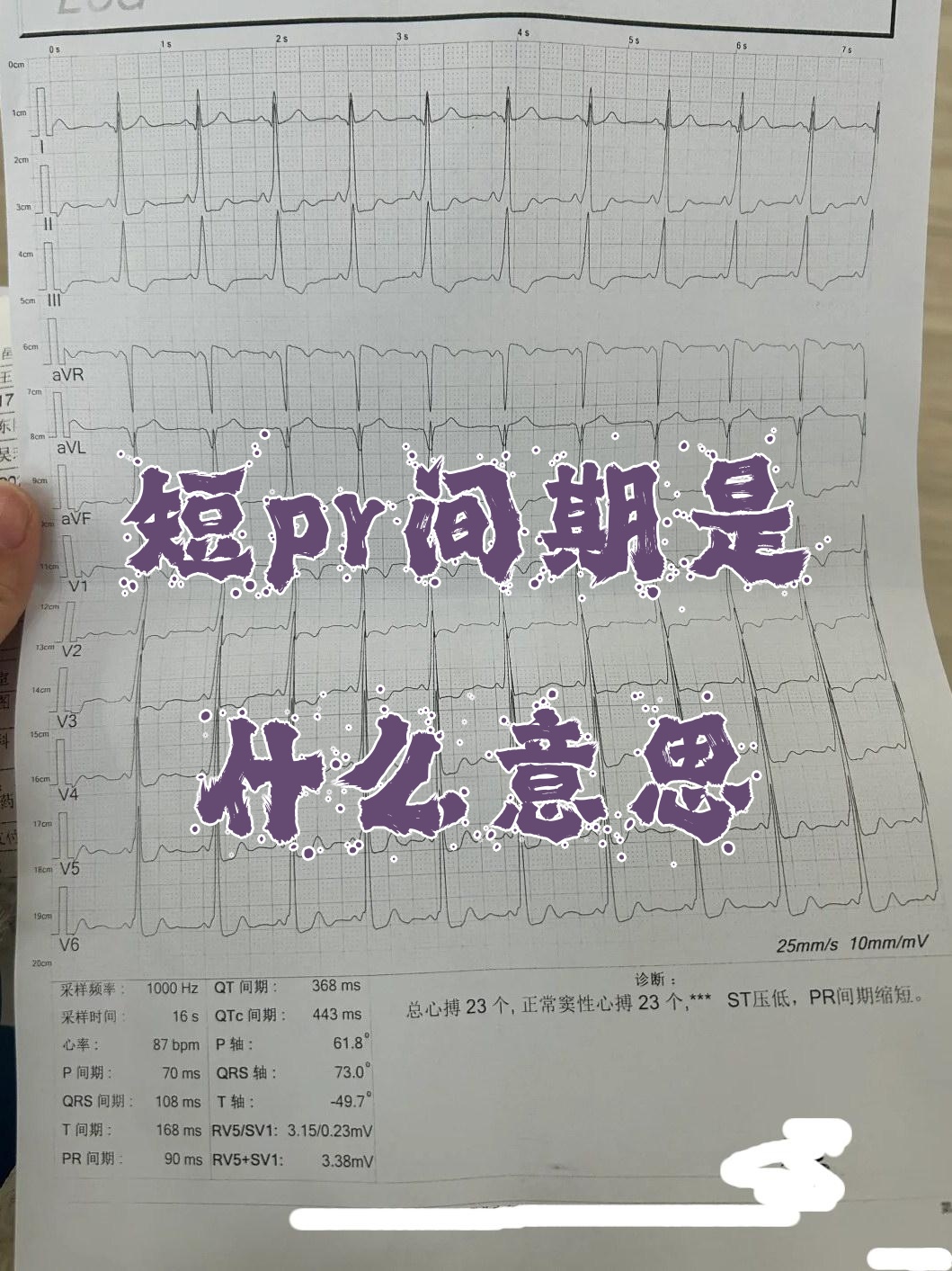 简单说,pr间期代表心房把信号传到心室的时间,一般是0.12到0