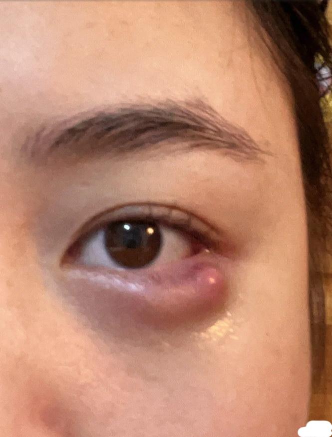 下眼皮长小疙瘩一般是"睑板腺囊肿"或者"霰粒肿",它们是因为油脂