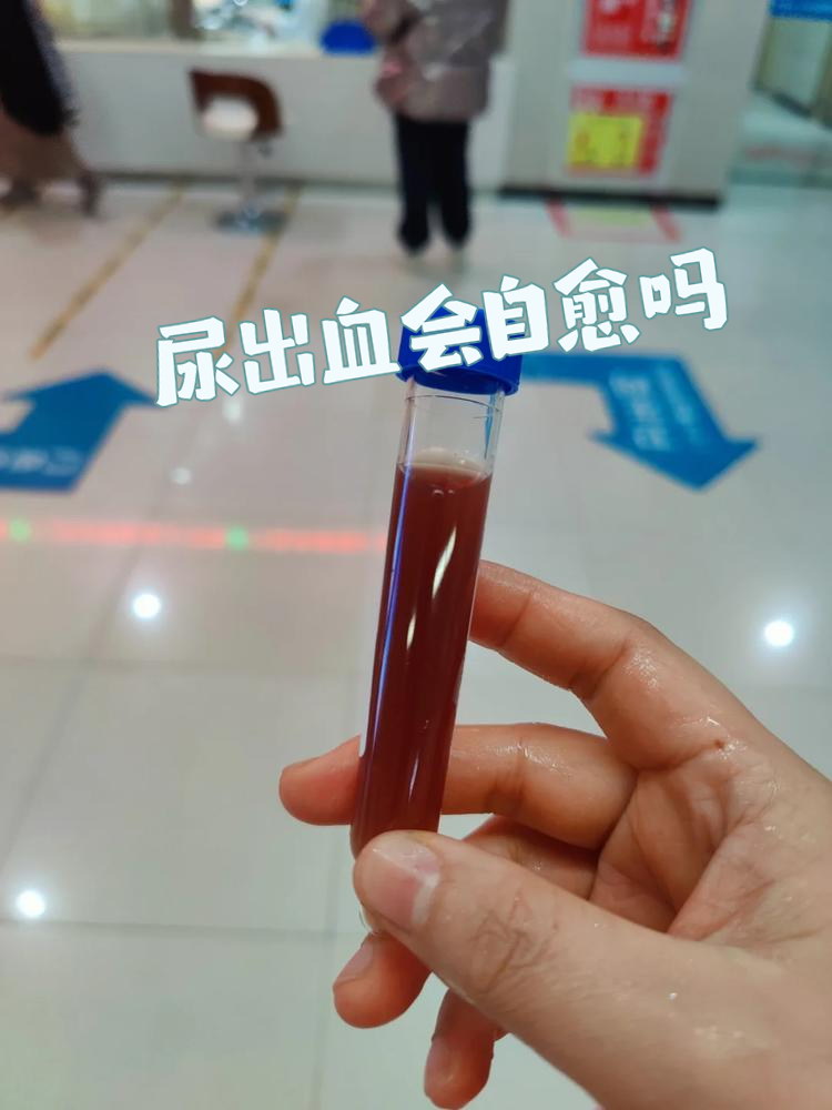 尿出血听起来就让人紧张,但别慌,先来了解一下情况
