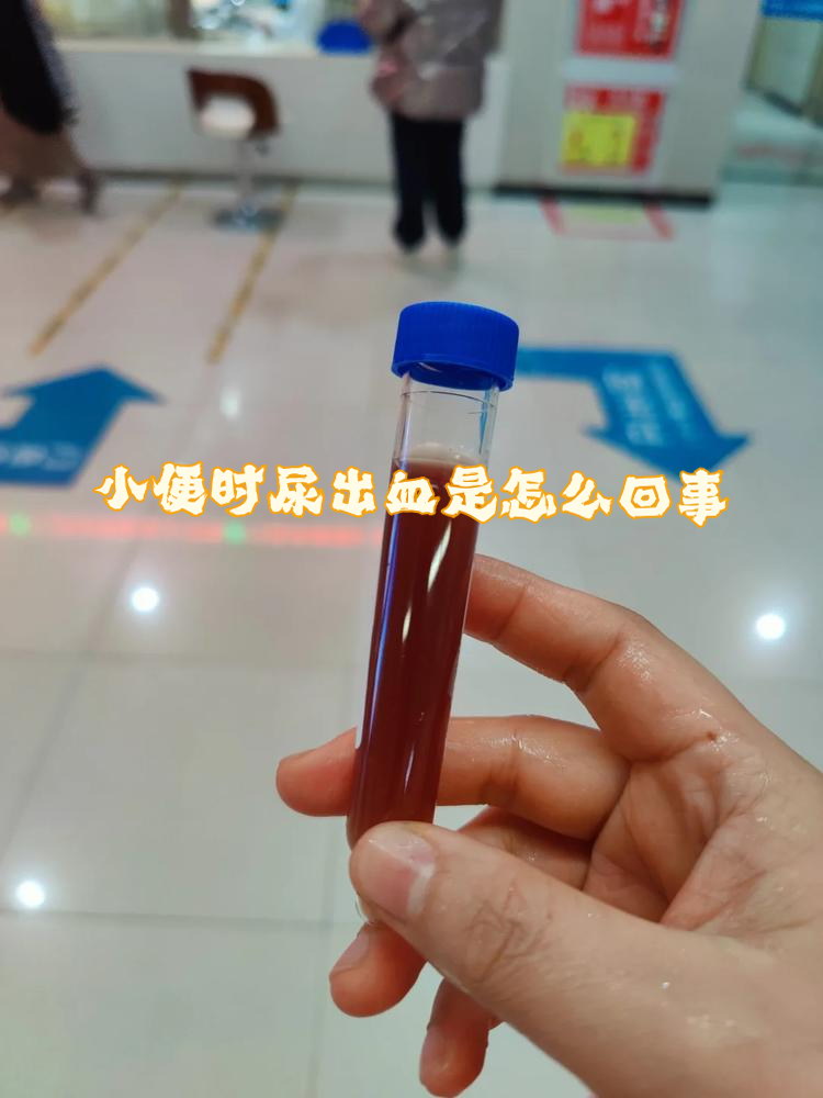 其实,尿血可能由多种原因引起,今天就来详细聊聊这个话题,希望能帮到