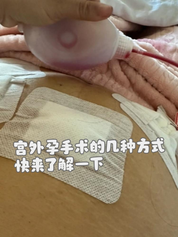 输卵管取胚术_输卵管取胚术和切除术一样吗  第2张