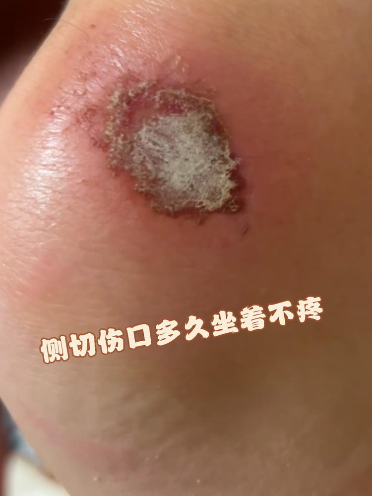 那么,侧切伤口多久坐着不疼呢?