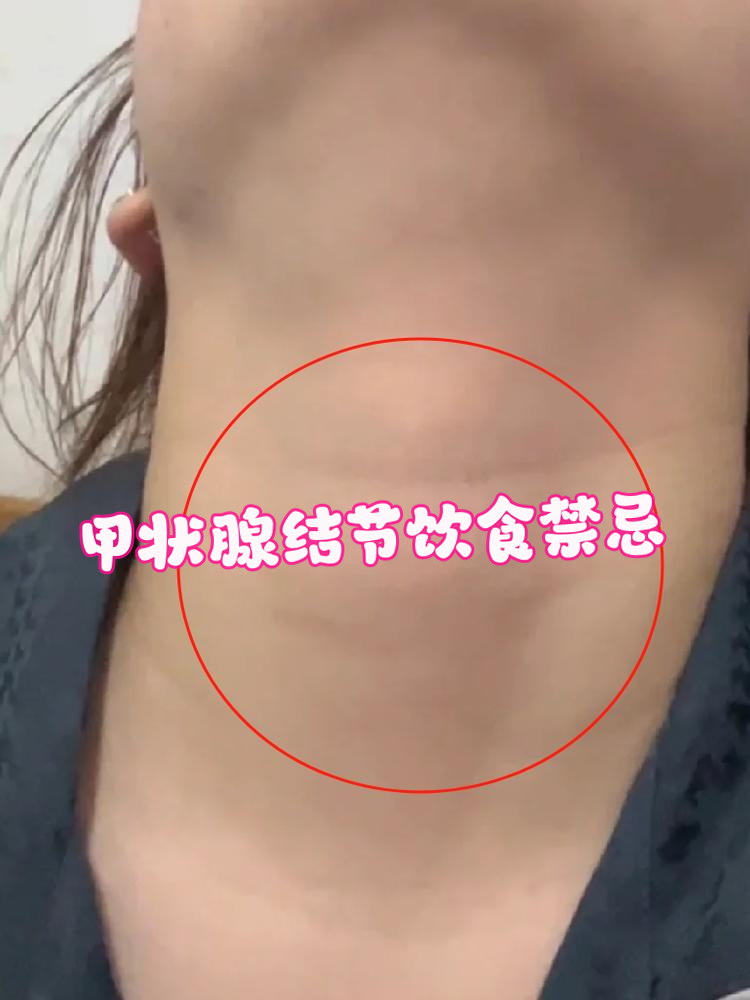 甲状腺结节是很多人体检时都会遇到的问题,虽然