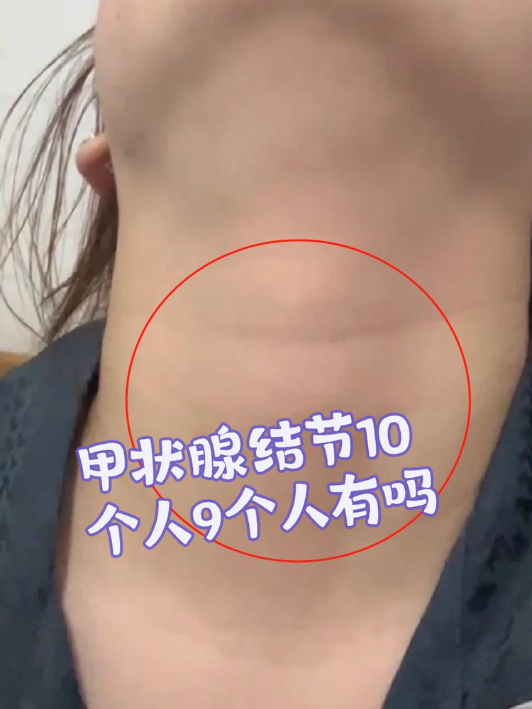 甲状腺结节10个人9个人有吗