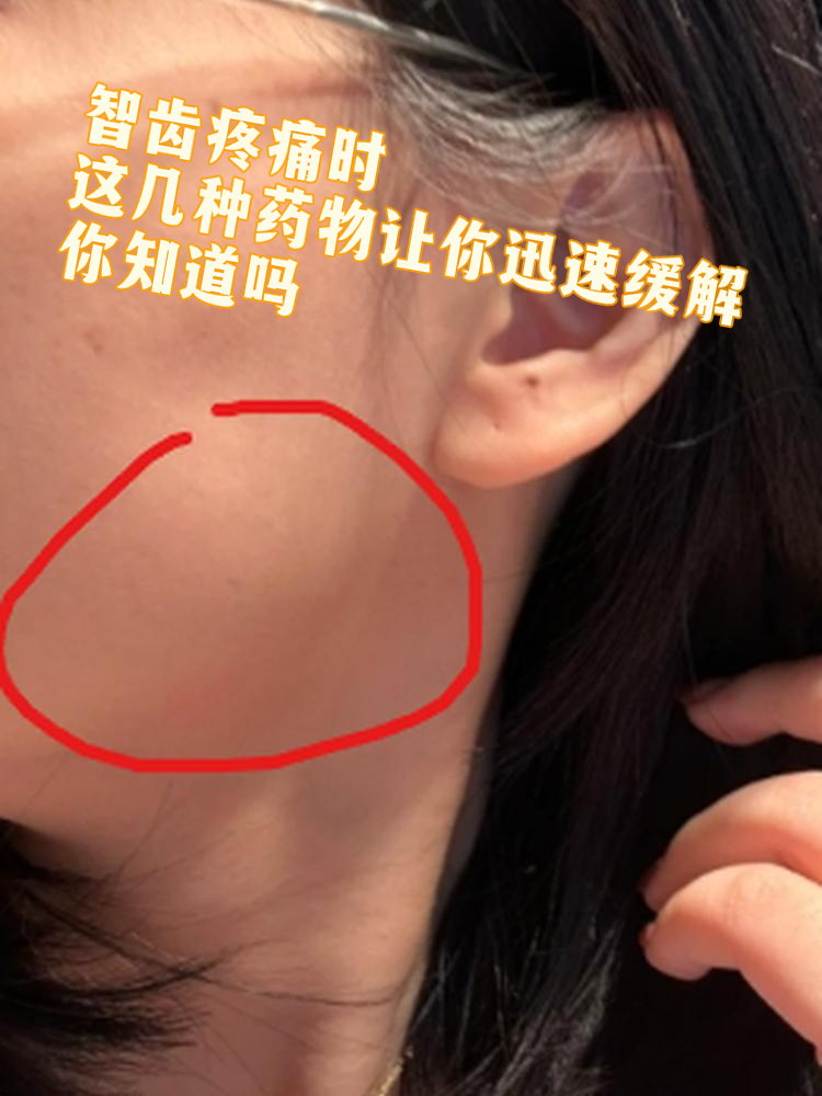 为什么拔智齿会脸肿其他牙不会为什么在线