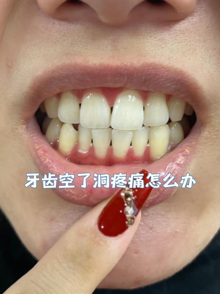 牙齿空了洞疼痛怎么办