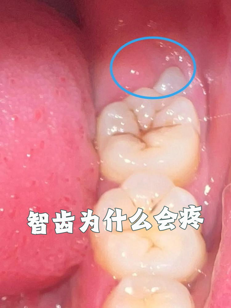 为什么智齿会横着长?要花几千块拔掉!为什么在线 为什么智齿会横着长?要花几千块拔掉!为什么在线