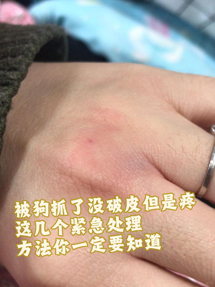 如果被狗抓了但并没有出现破皮流血的情况,也不要掉以轻心