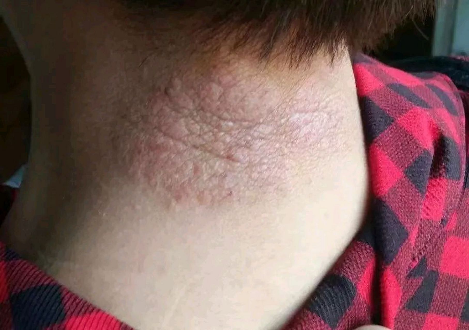 这个不是癣,是神经性皮炎,用一些常规葯如达克宁没有用,会越来越大.