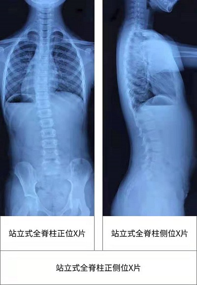 儿童青少年脊柱侧弯自我检测的方法和步骤