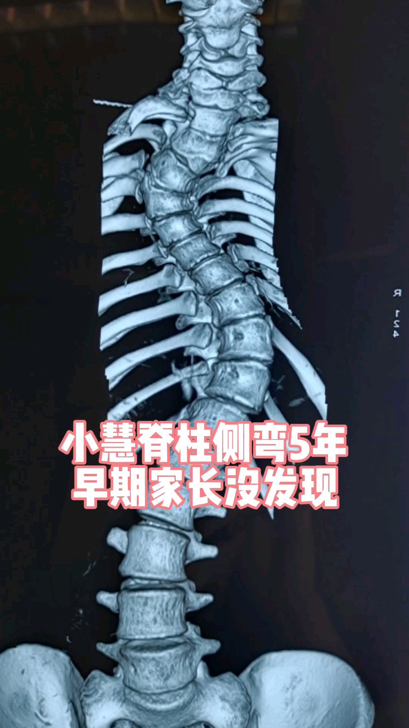小慧脊柱侧弯仅仅5年脊柱就扭曲成这样家长一定要注意
