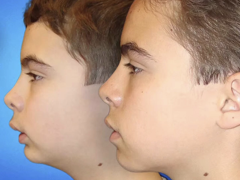 千万不要再口呼吸了!真的会越来越丑!