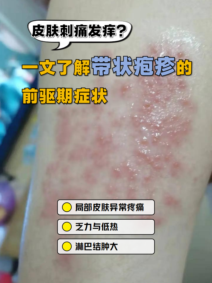带状疱疹前驱期症状隐蔽,容易被忽略,但早期识别能减少神经痛风险