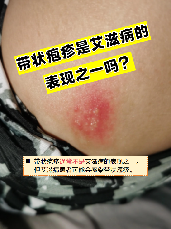 带状疱疹是艾滋病的表现之一吗?