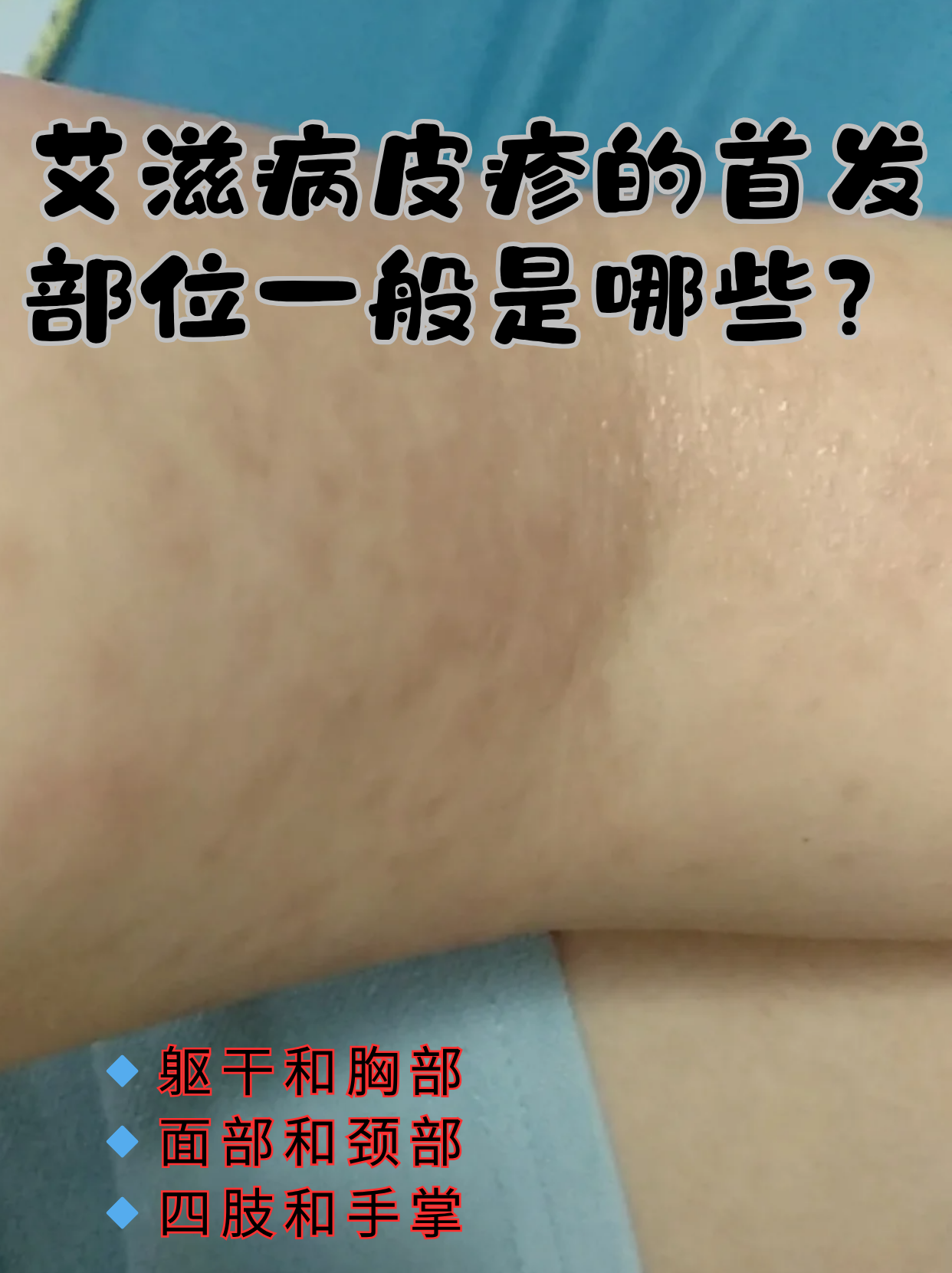 皮疹是艾滋病早期可能出现的症状之一,但并非所有皮疹都与艾滋病