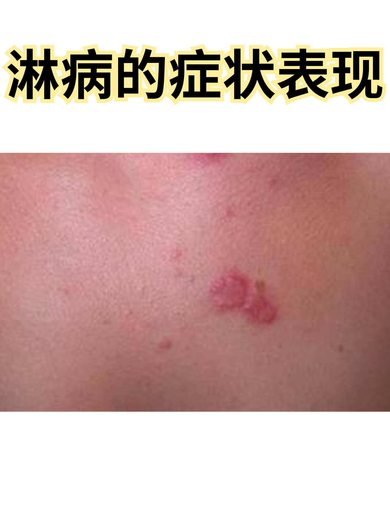 淋病是一种常见的性传播疾病,由淋球菌感染引起,悄悄