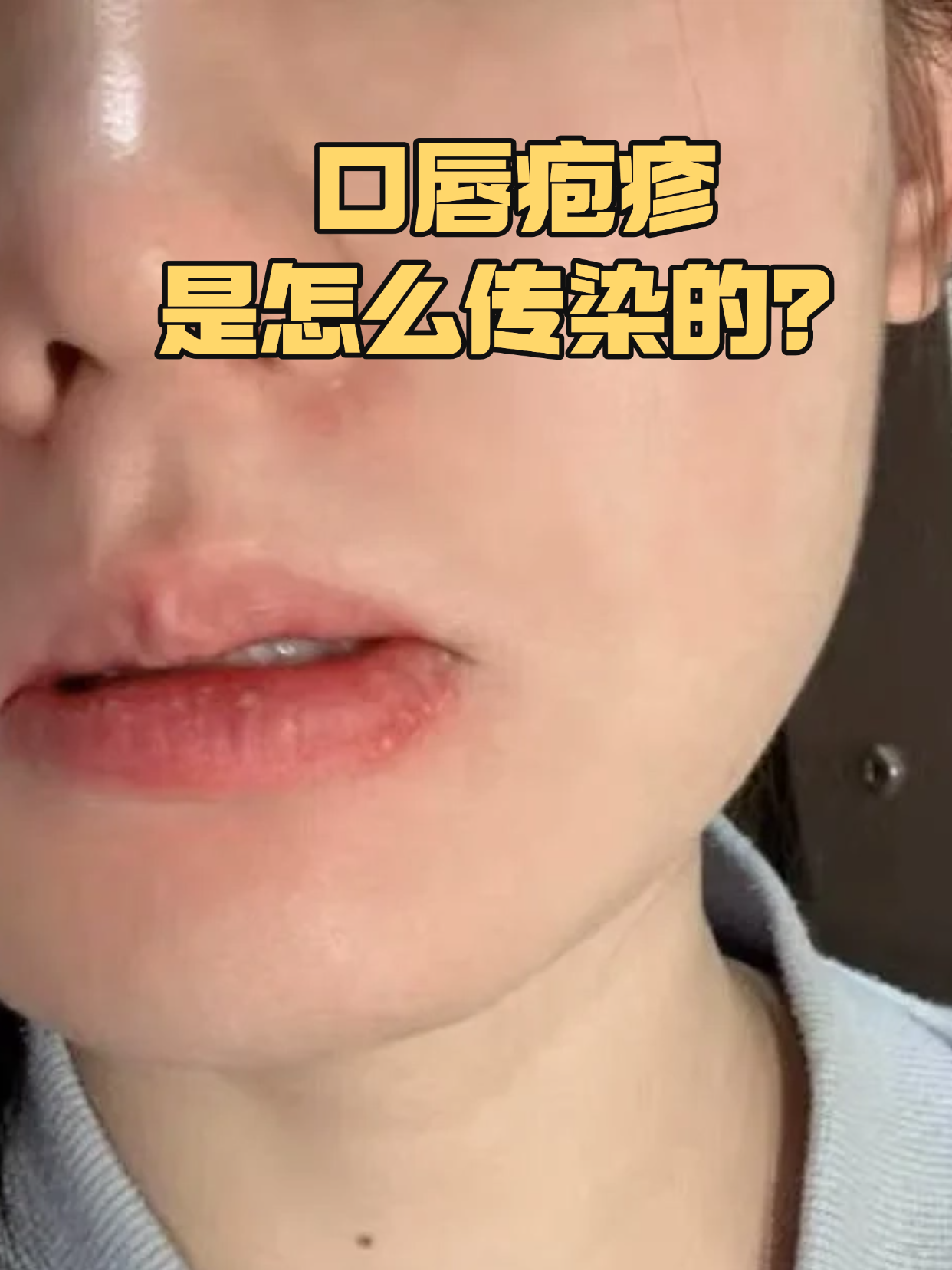 夏天总有人嘴角突然冒出小水泡,又痒又痛还容易破,这就是口唇疱疹在