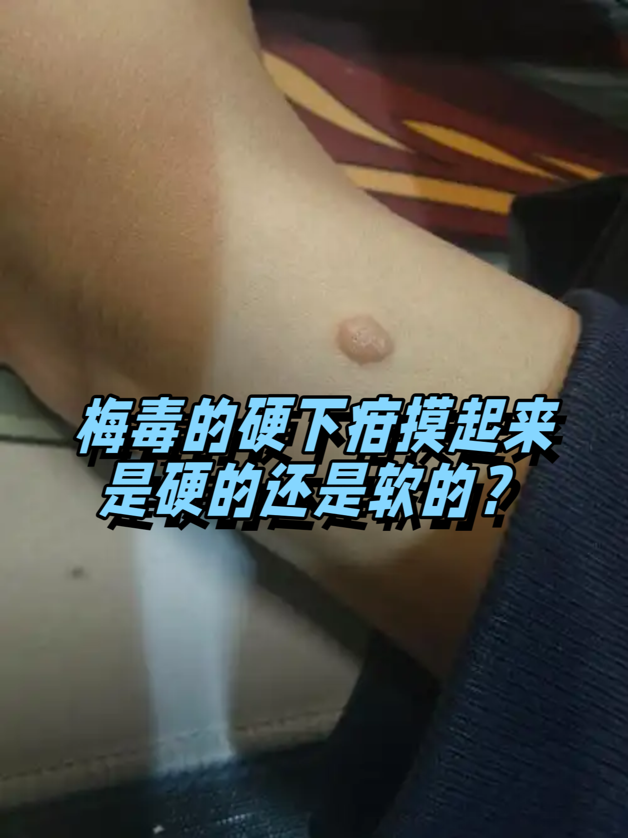 梅毒的硬下疳初期触感像软骨,表面光滑但边界清晰,这种特征性溃亚是