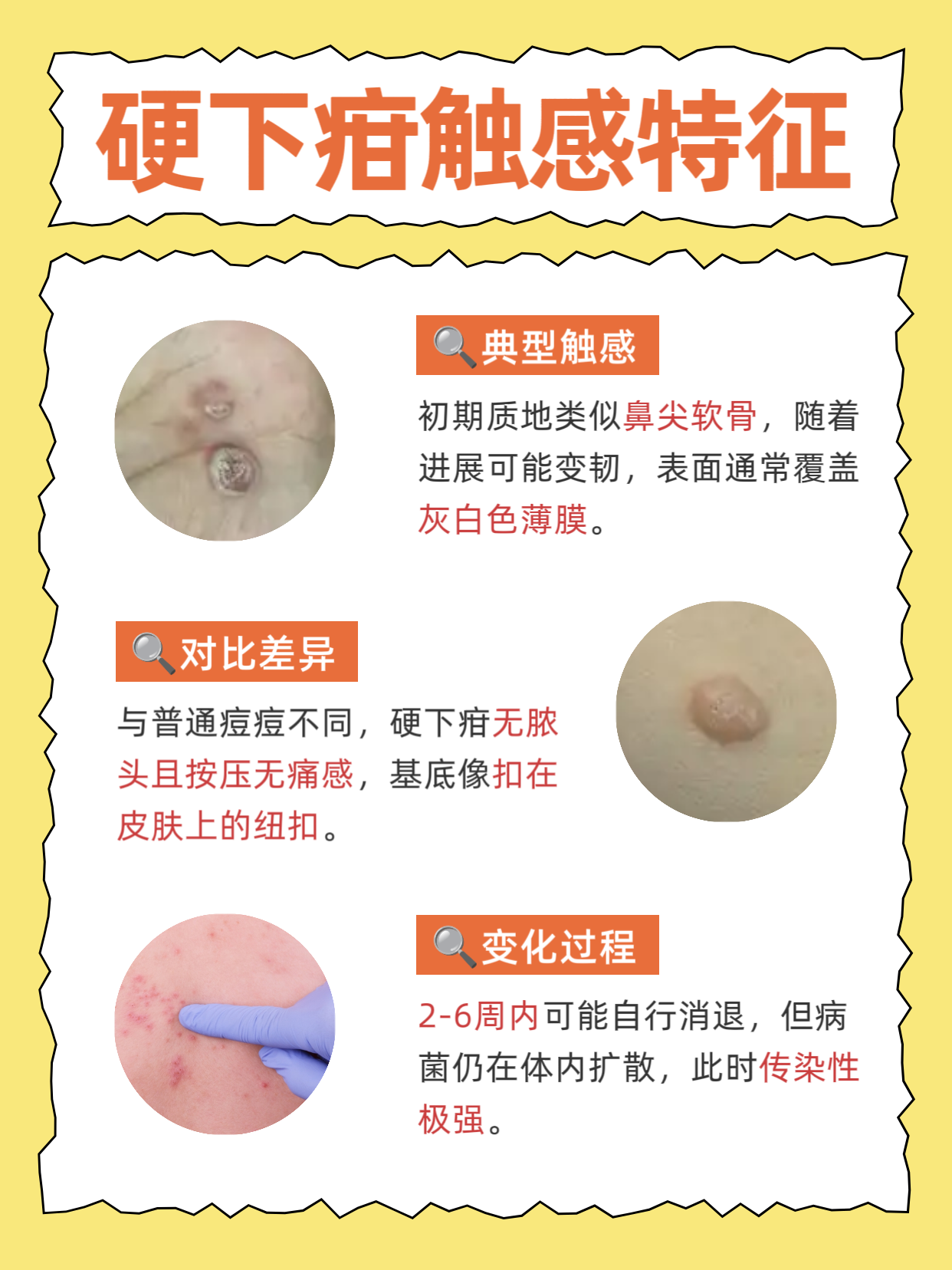 梅毒的硬下疳摸起来是硬的还是软的?