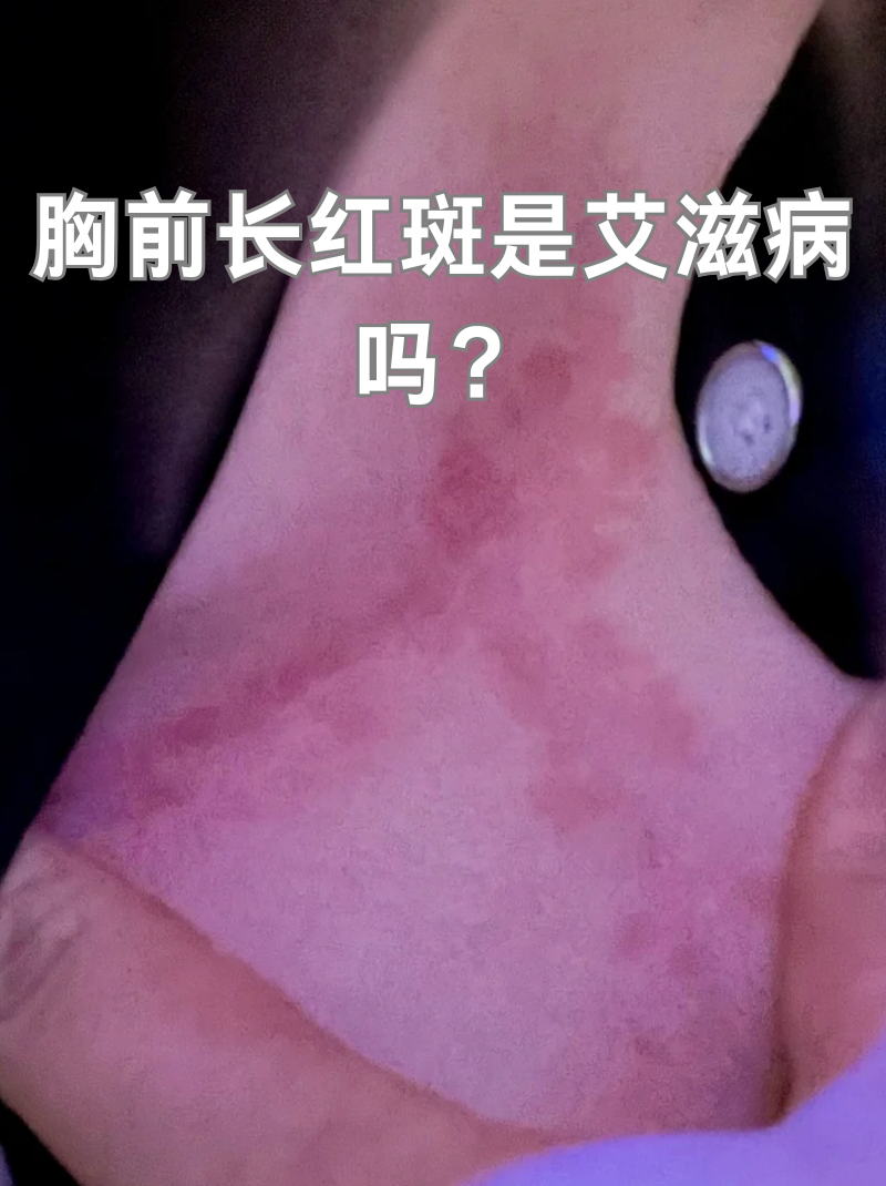 胸前长红斑是艾滋病吗?