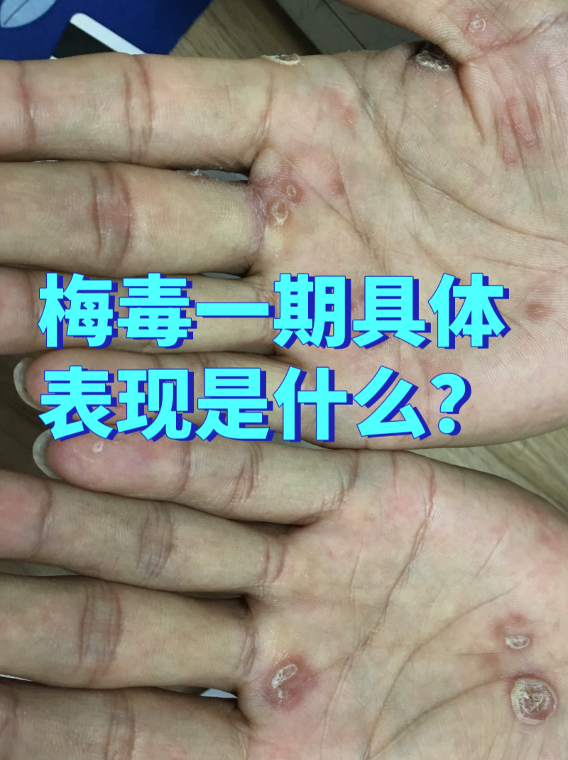 一期梅毒典型症状 硬下疳特点:常出现在生殖器