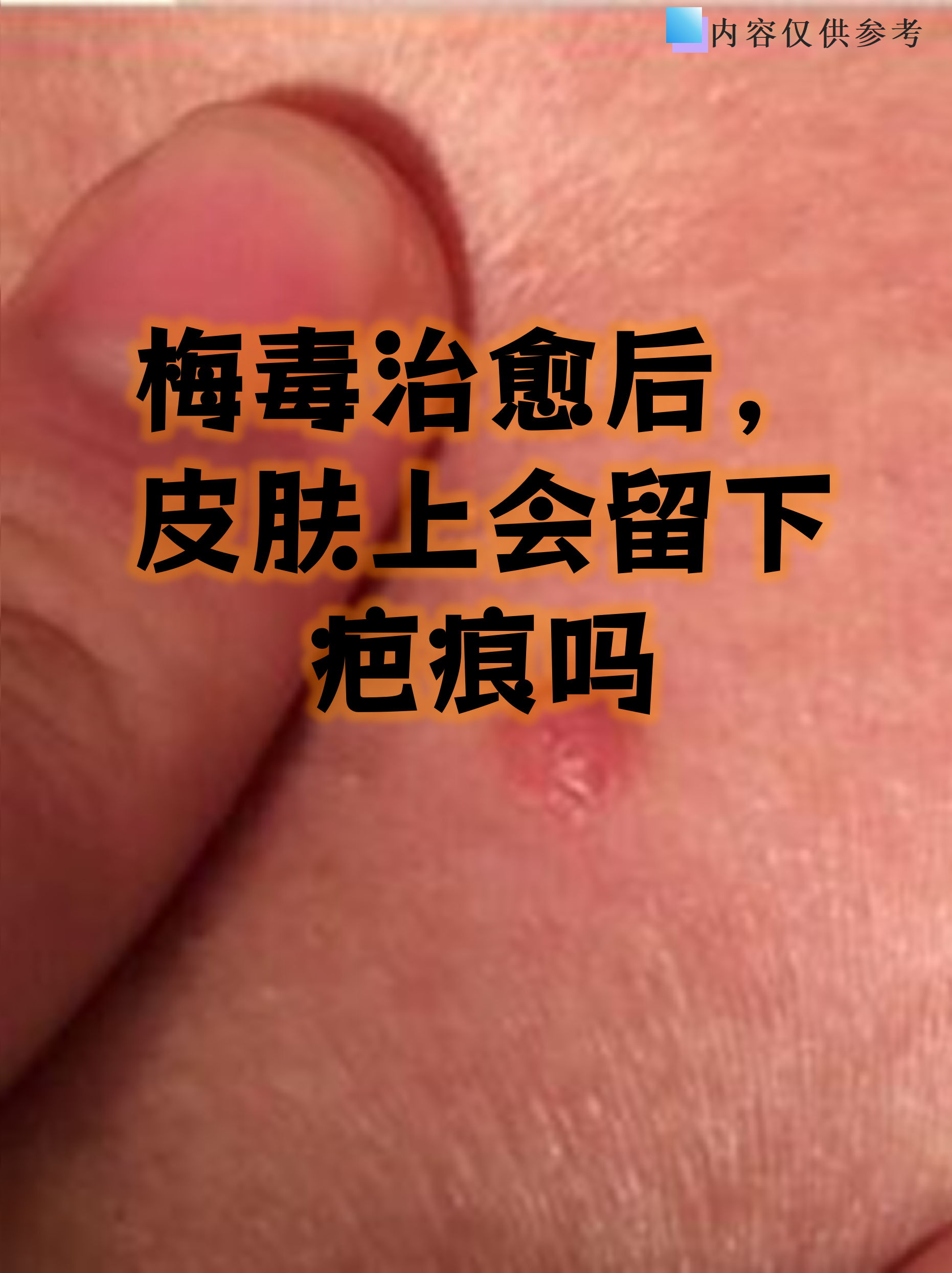 梅毒治愈后,皮肤上会留下疤痕吗