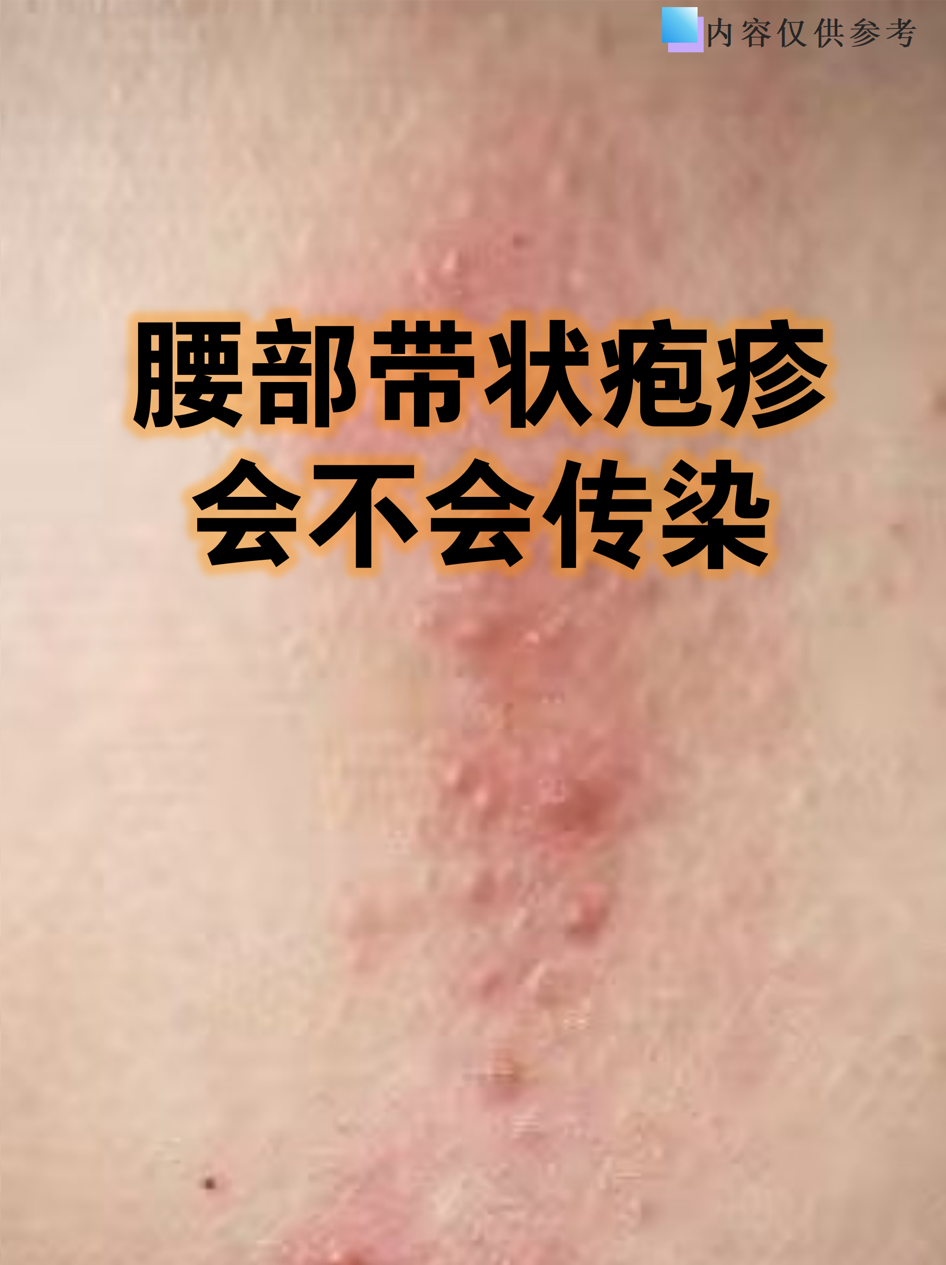 腰部带状疱疹会不会传染