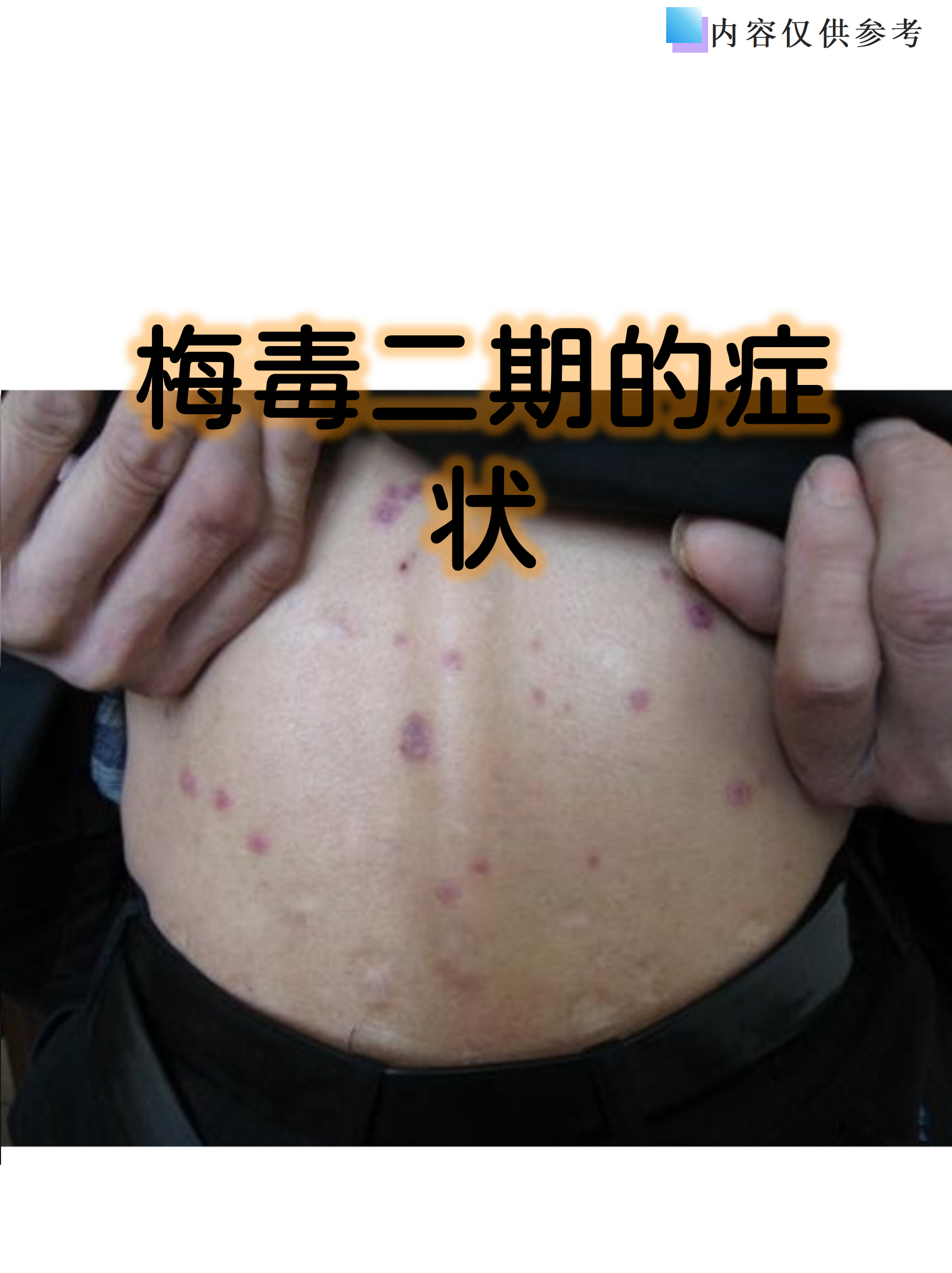 梅毒二期是梅毒螺旋体感染后的一个重要阶段,通常在