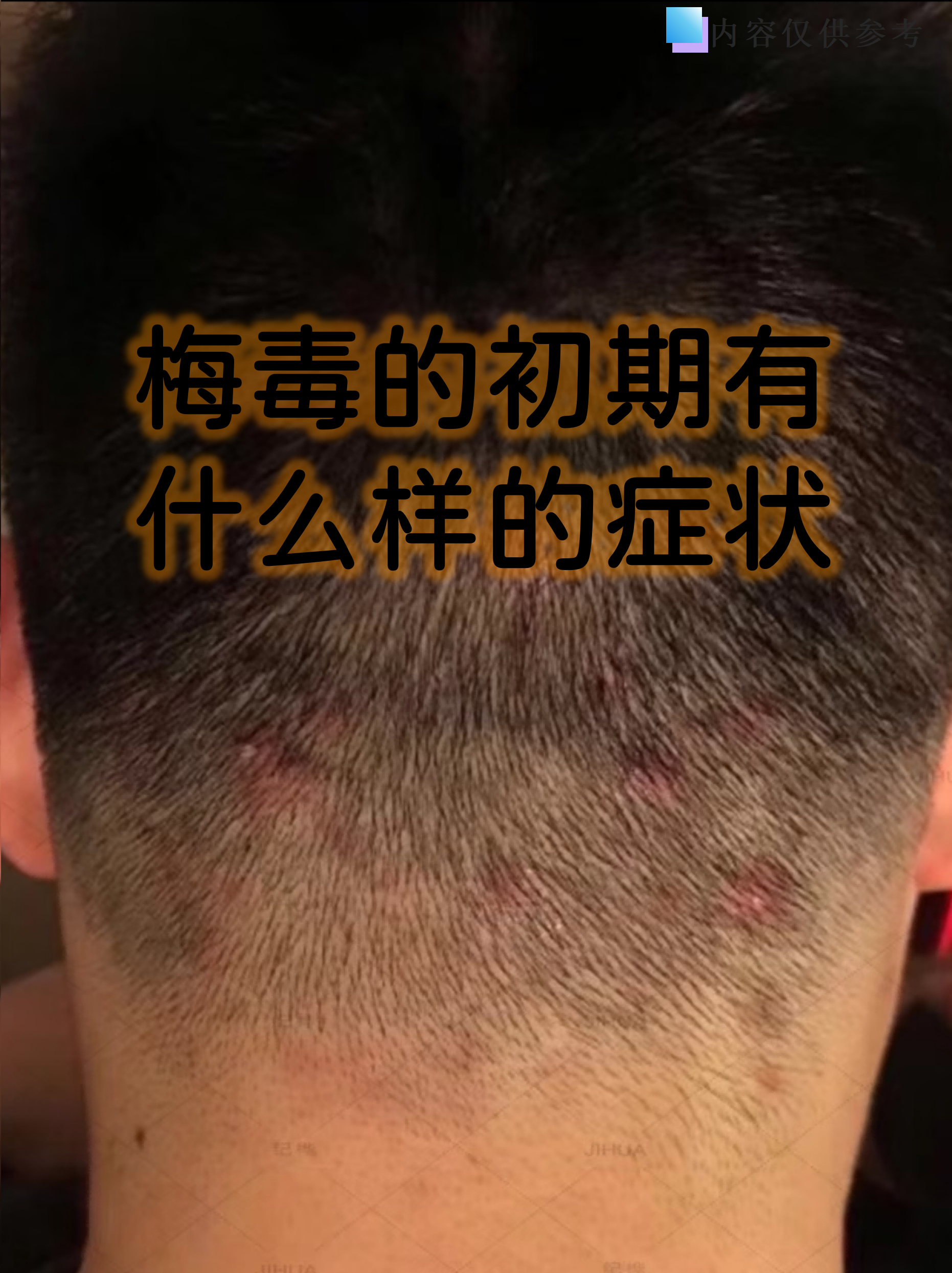 梅毒的初期有什么样的症状