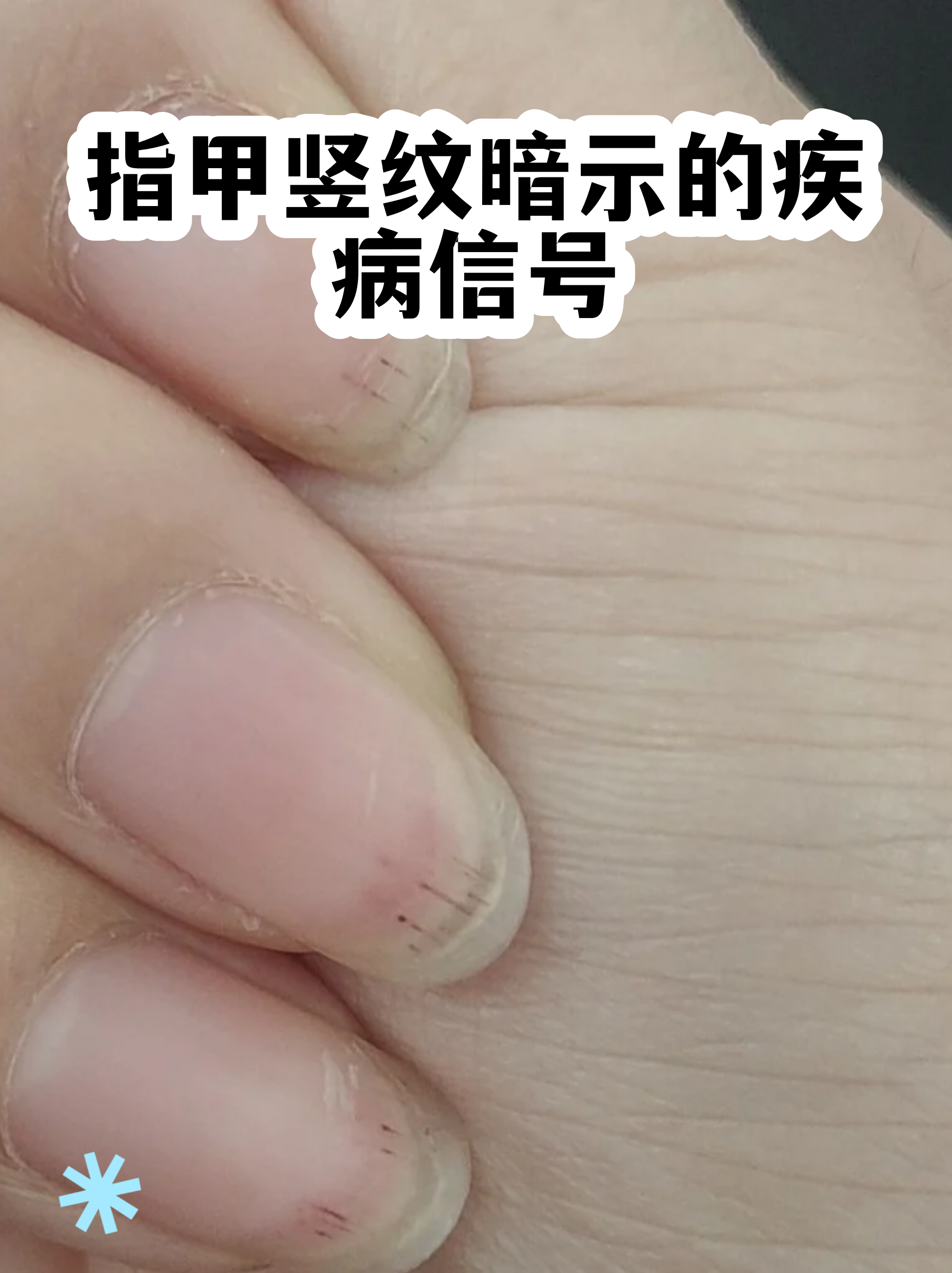 无名指下这条竖纹变浅说明什么