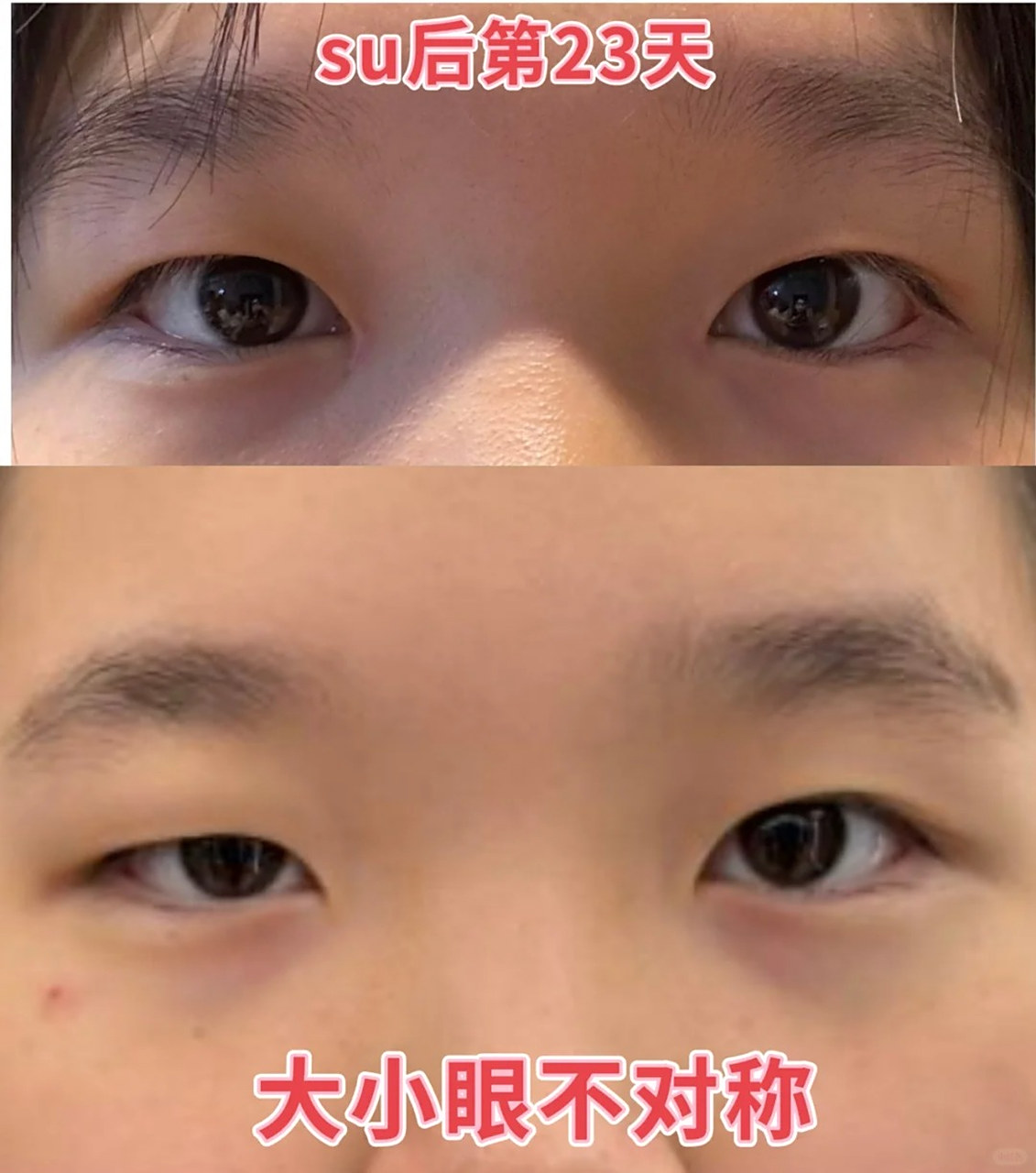 23天恢复自然状态[互粉]  不想被看出做过双眼皮,所以宽度很窄,恢复后