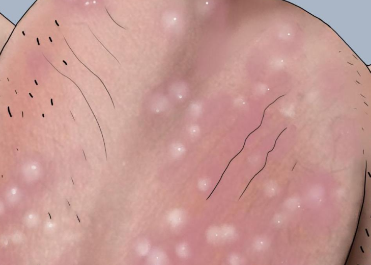 阴囊皮肤薄而敏感,局部的毛孔堵塞,轻微感染或皮肤结构变化,都可