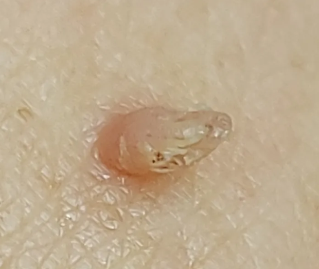 男性下面长了长条状肉芽?