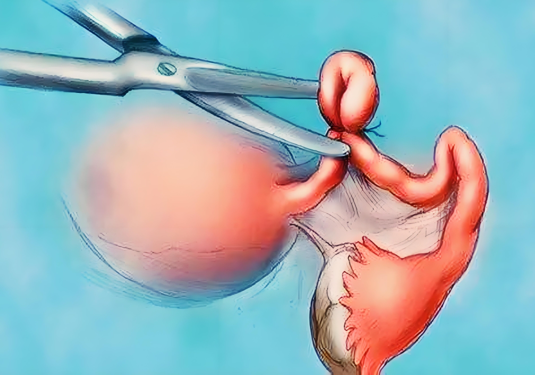 男性结扎影响性功能?