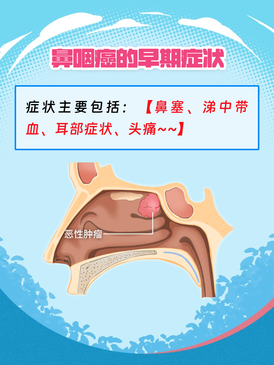 鼻咽癌,早期症状可能不明显,但了解这些症状有助于及
