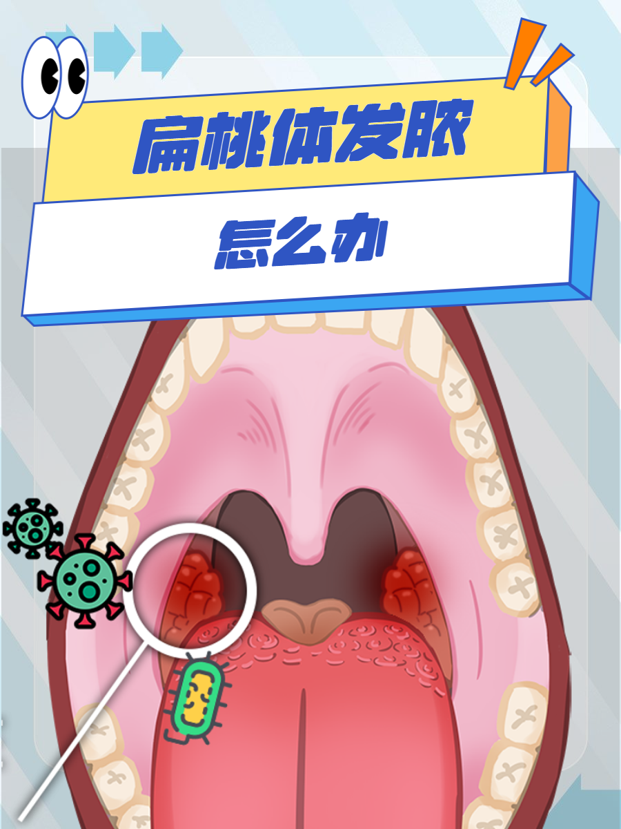 抗生素治疗:如果扁桃体发脓由细菌感染引起,应在医生的