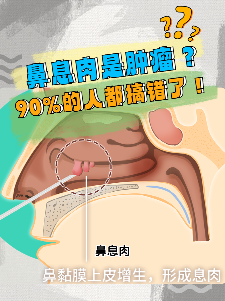 鼻息肉是鼻腔和鼻窦黏膜的慢性炎症性疾病鼻息肉鼻息肉和正常鼻子