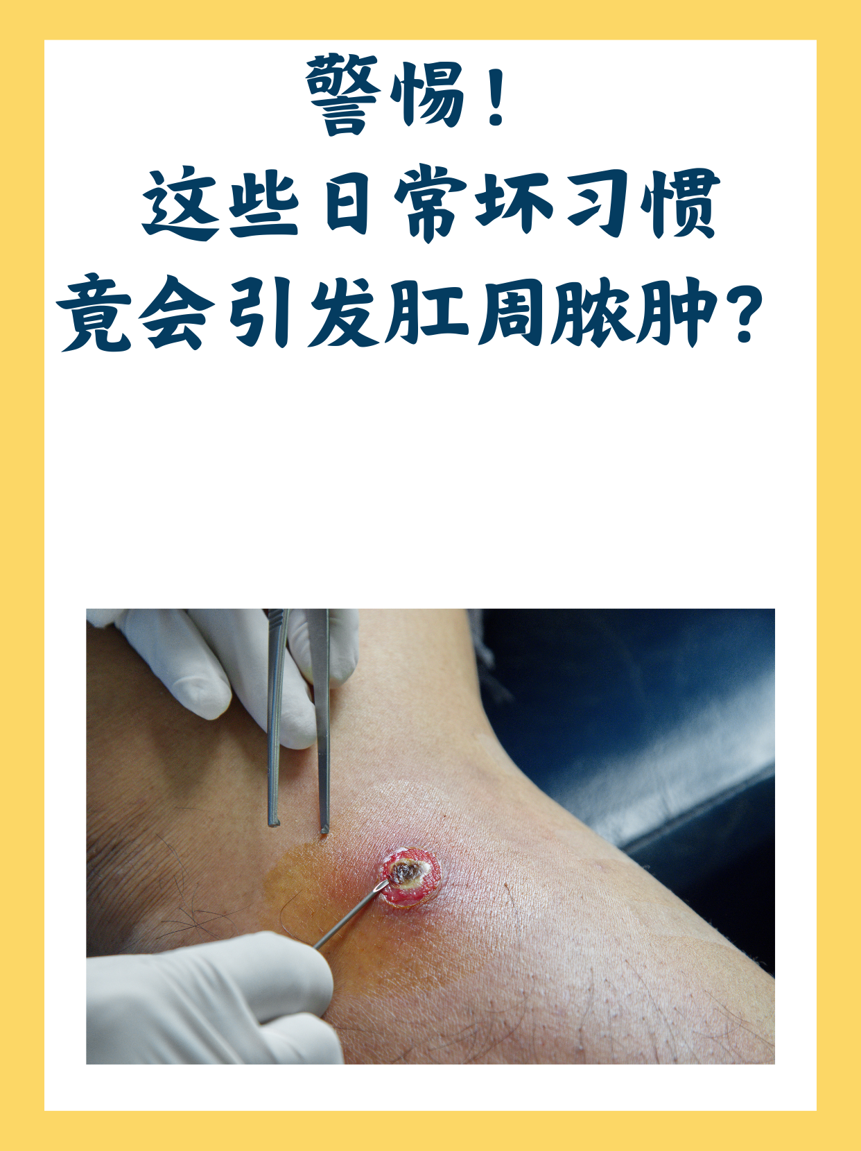生活中,你是否忽视了肛门周围的不适?